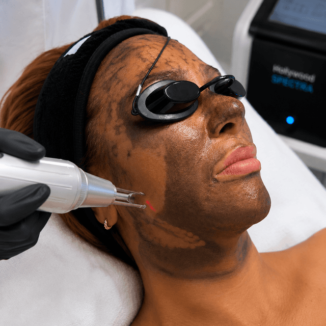 Carbon Peel-3 Sessions at The Beauty Nest Studio in Yonkers, NY